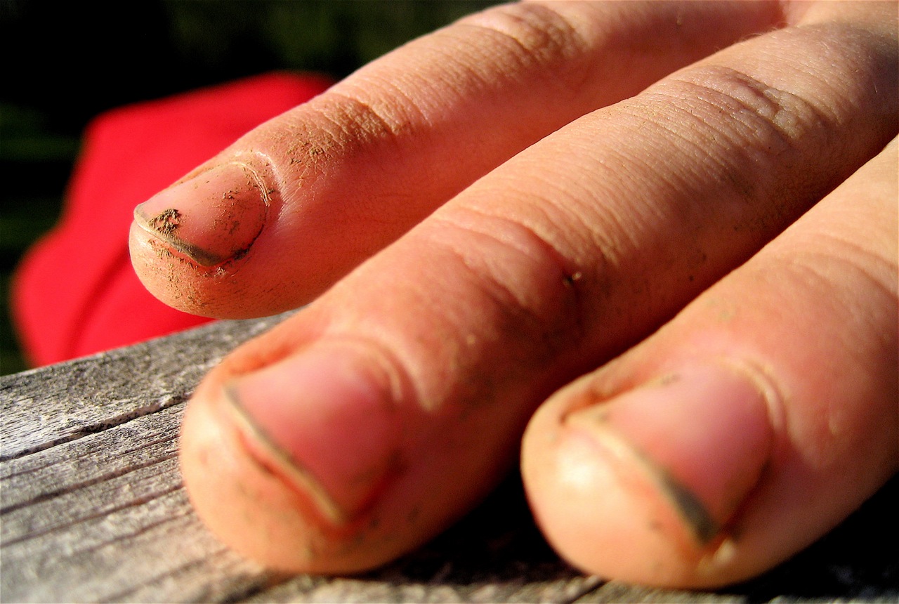 dirt under fingernails